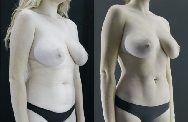 Beverly Hills Mini Tummy Tuck Before and After