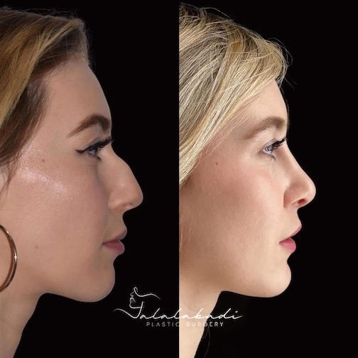 Beverly Hills Nose Reshaping