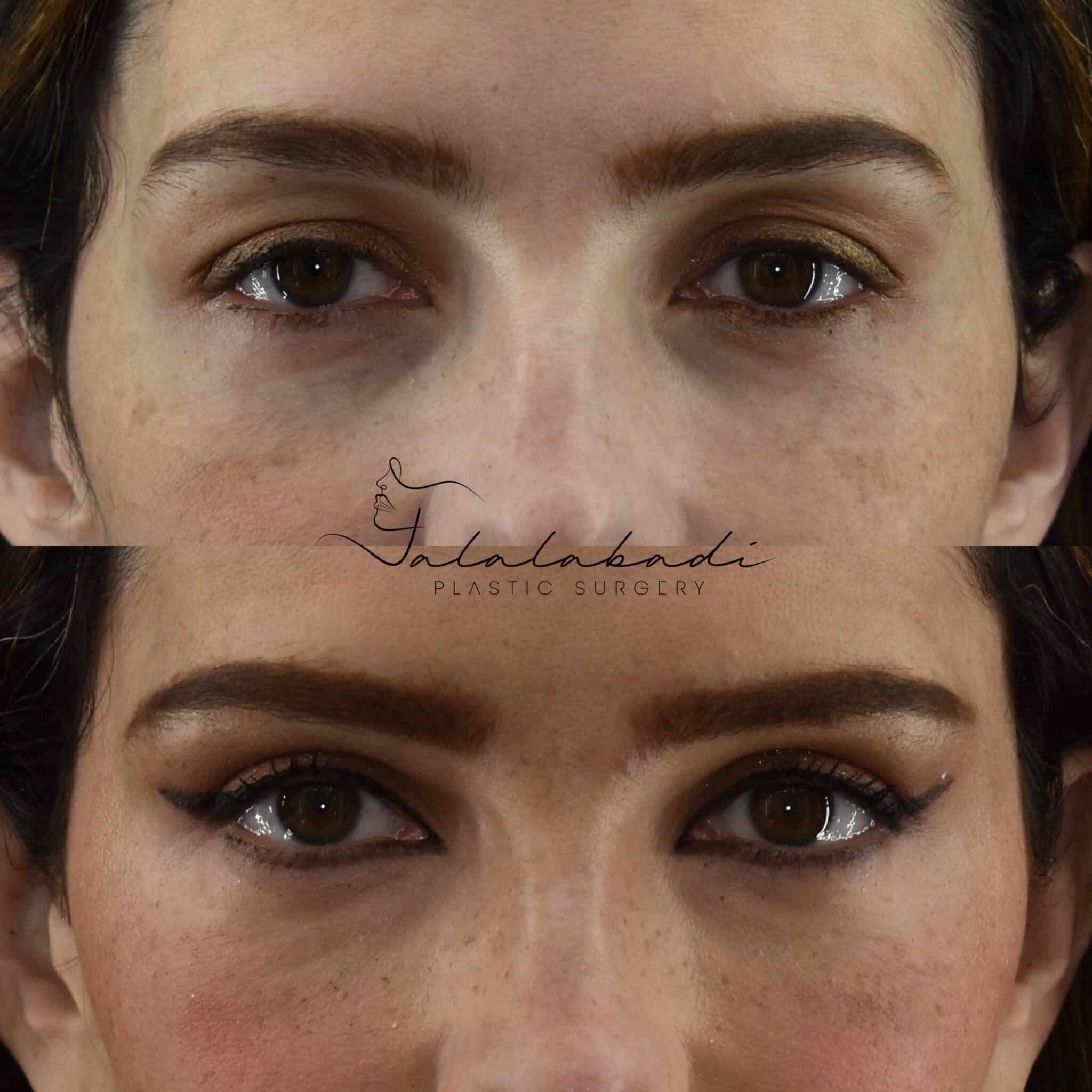 Blepharoplasty Before and After Beverly Hills