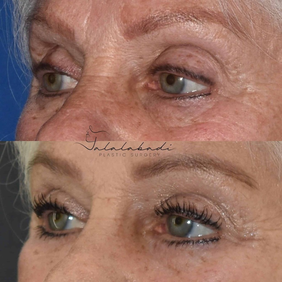 Blepharoplasty-Upper-Lower-Patient-1-scaled-1