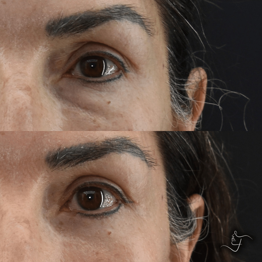 Blepharoplasty-Upper-Lower-Patient-2-1