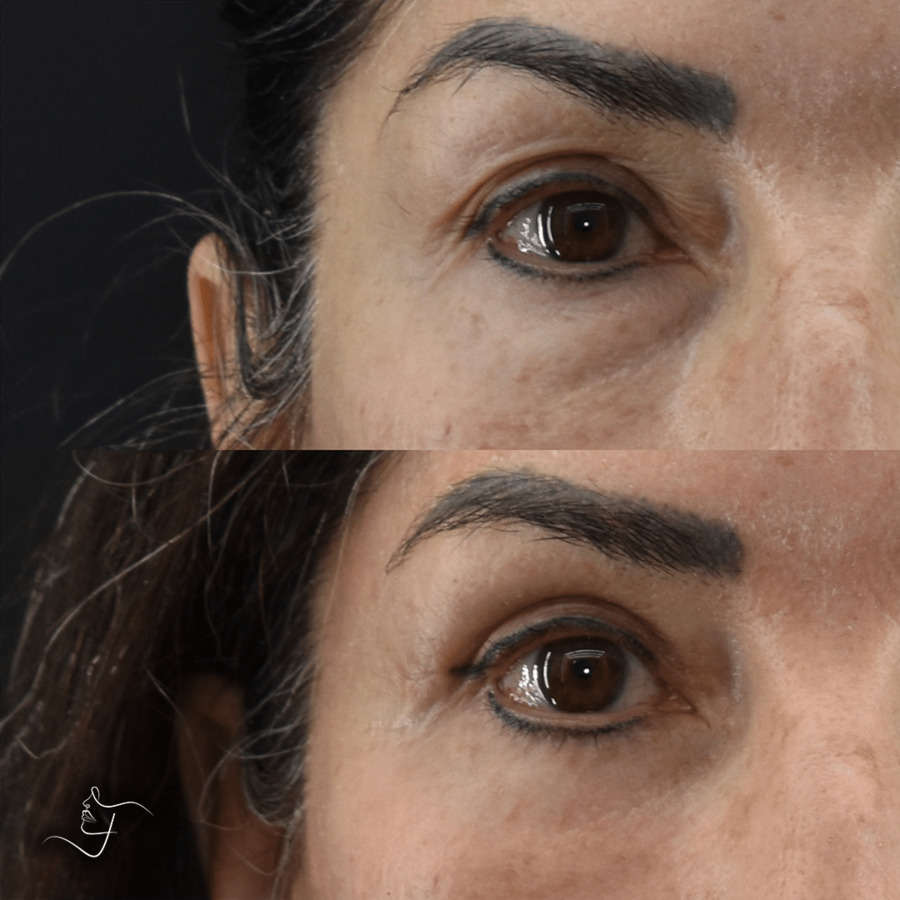 Blepharoplasty-Upper-Lower-Patient-2-2