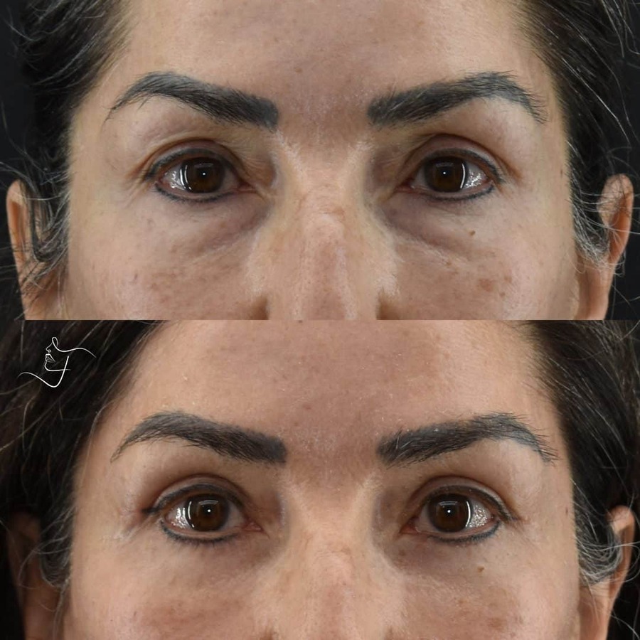 Blepharoplasty-Upper-Lower-Patient-2-3