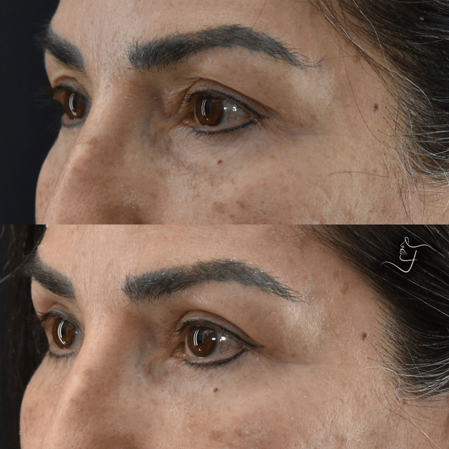 Blepharoplasty-Upper-Lower-Patient-2-4