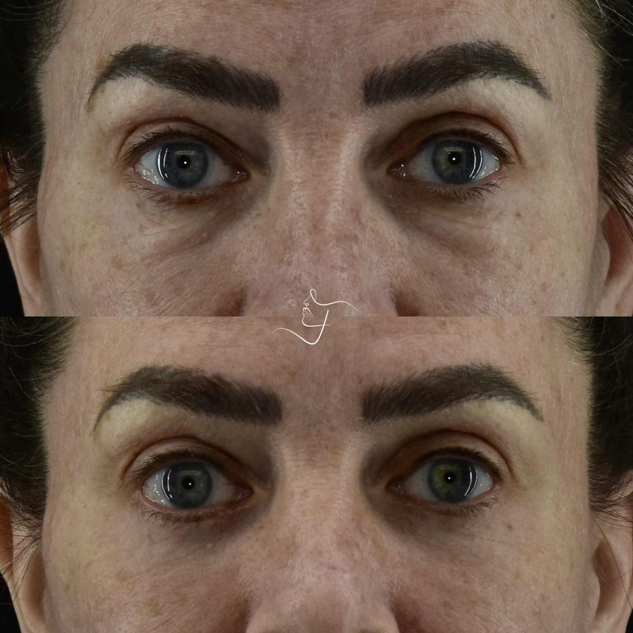 Blepharoplasty-Upper-Lower-Patient-3-scaled-1