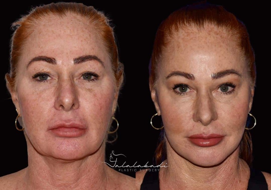 Blepharoplasty-Upper-Lower-Patient-6-1