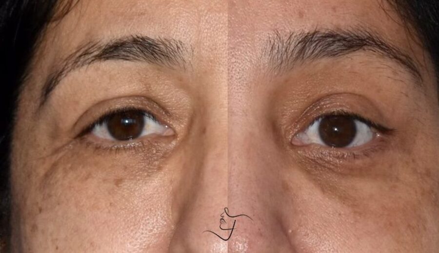 Blepharoplasty-Upper-Patient-4