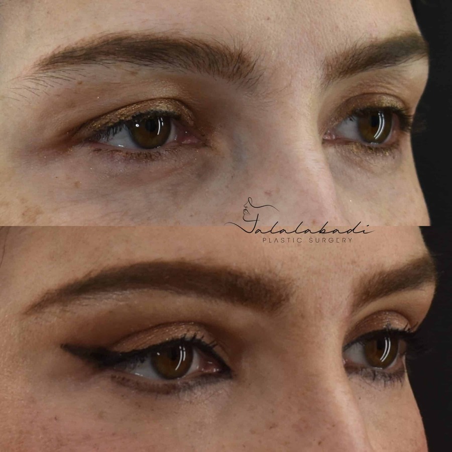 Blepharoplasty-Upper-Patient-5-1-scaled-1