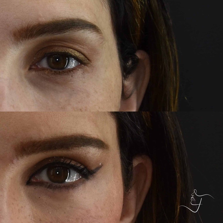 Blepharoplasty-Upper-Patient-5-2-scaled-1