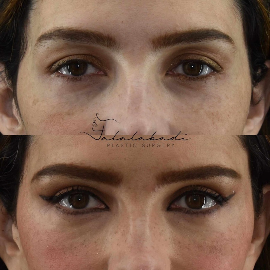 Blepharoplasty-Upper-Patient-5-4-scaled-1