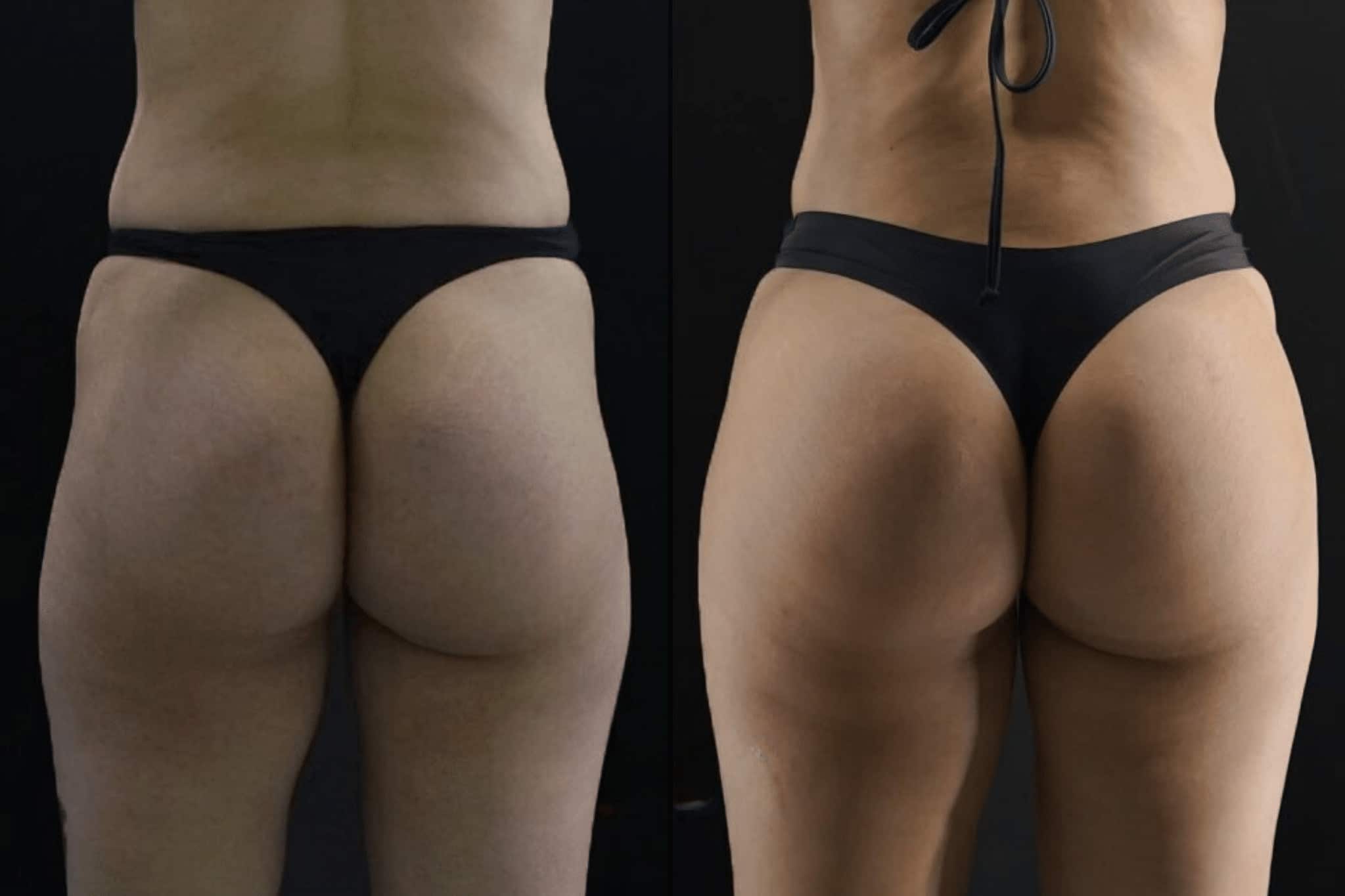 Brazilian Butt Lift Cost - Beverly Hills Physicians