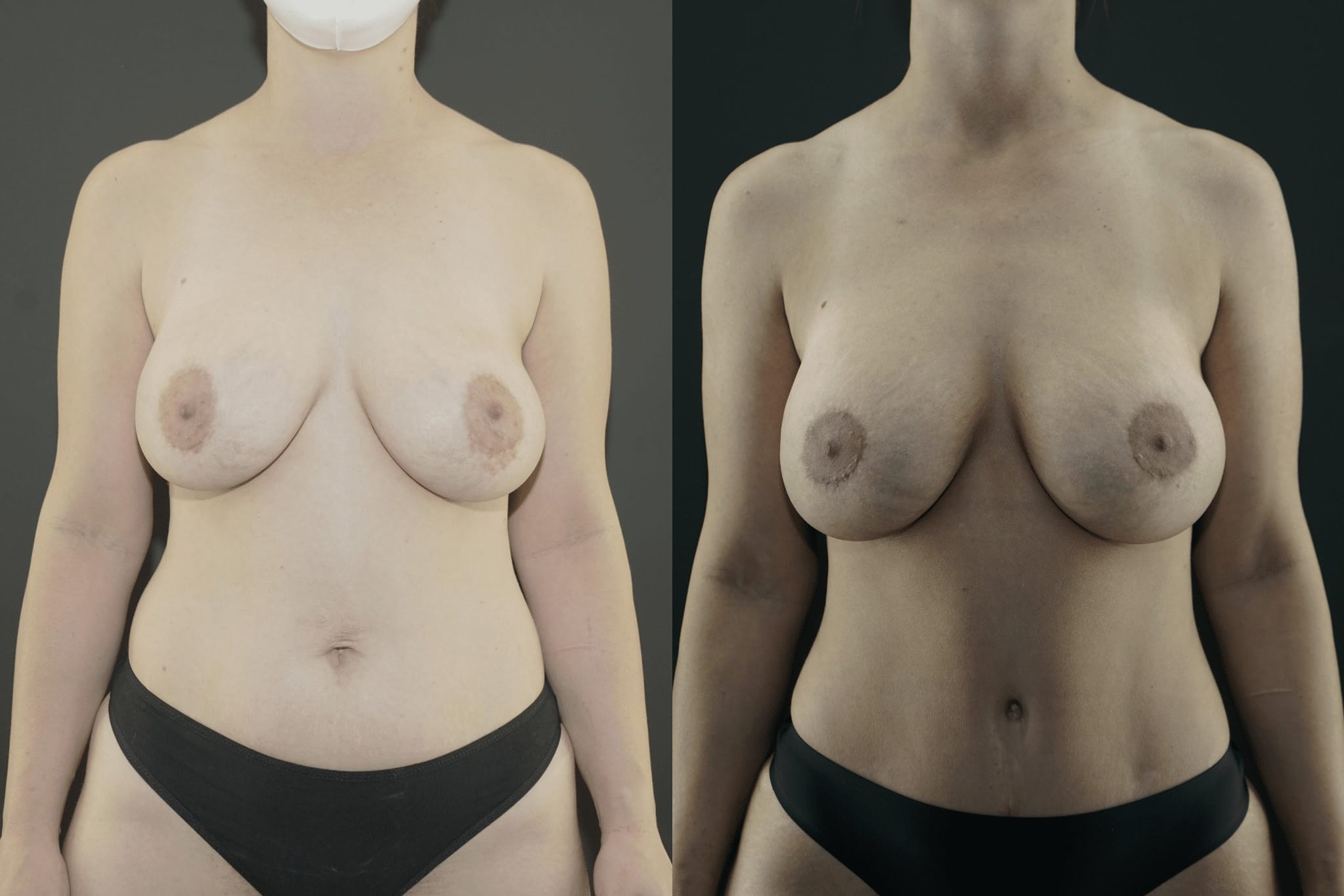 Breast Implant Revision Before and After Beverly Hills