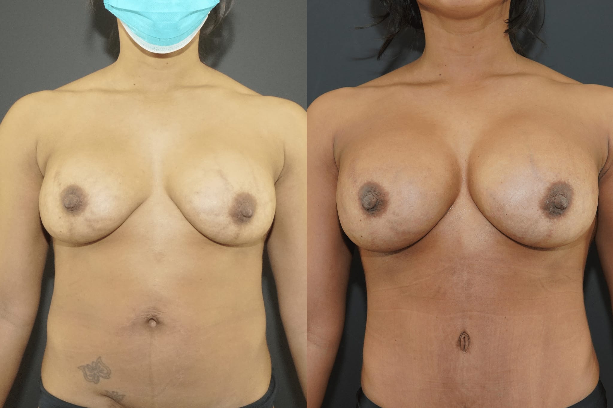 Breast Implant Revision in Beverly Hills