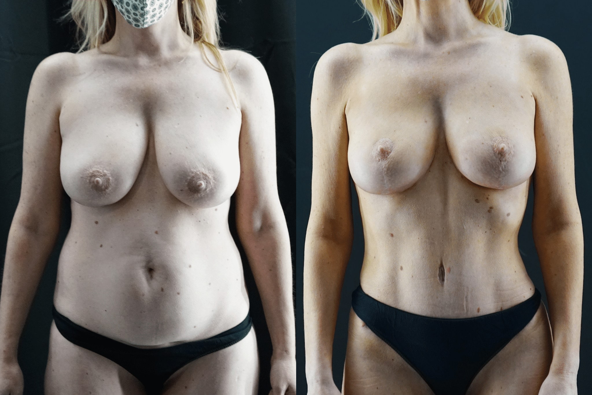 Breast Lift in Beverly Hills