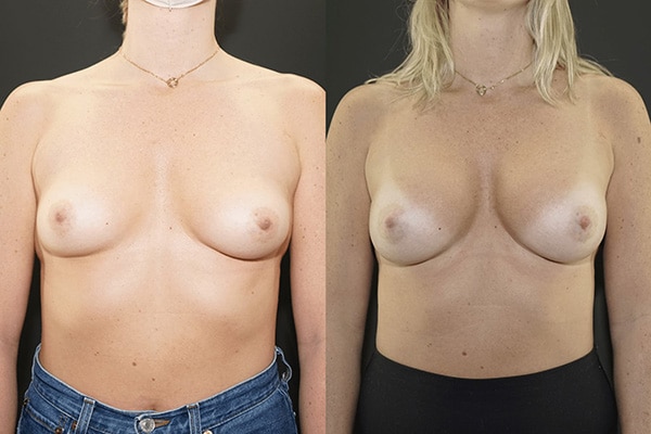 Breast augmentation size options