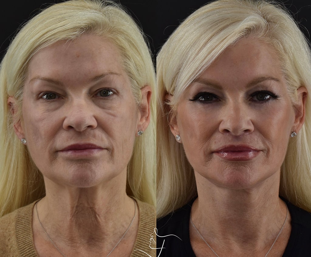 Facelift in Beverly Hills