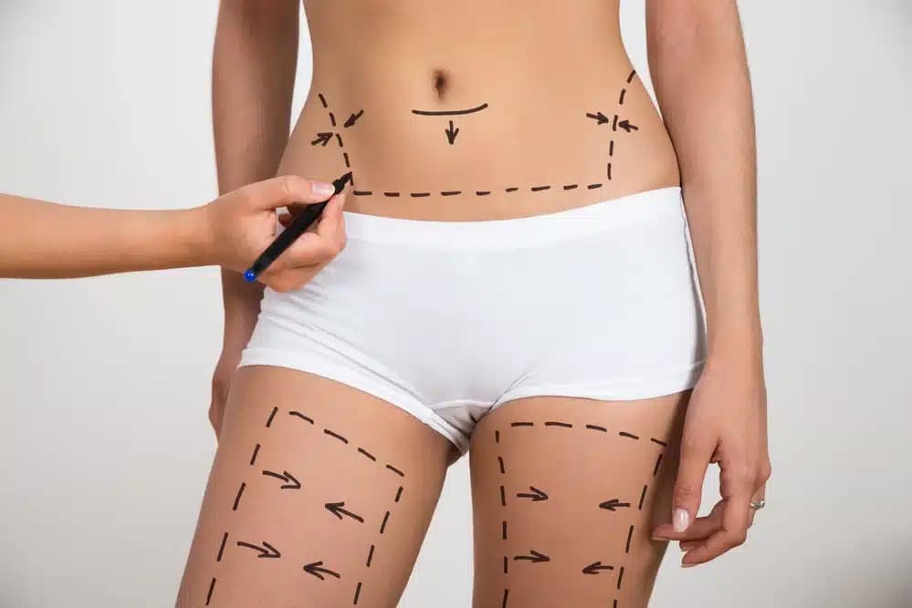 How Does Liposuction Work