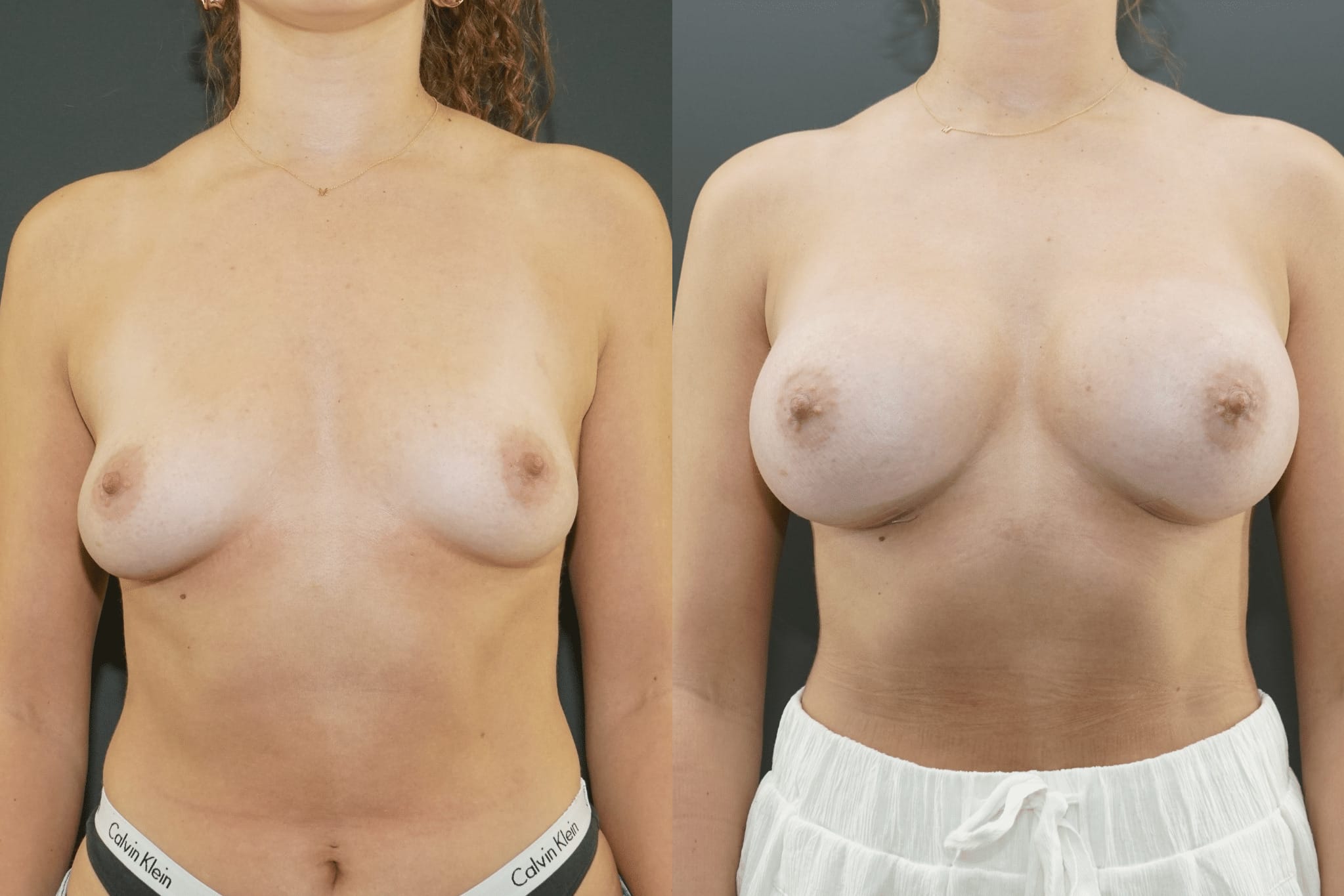 How to sleep after breast augmentation surgery