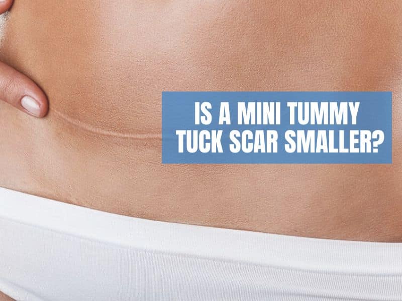 Is a Mini Tummy Tuck Scar Smaller