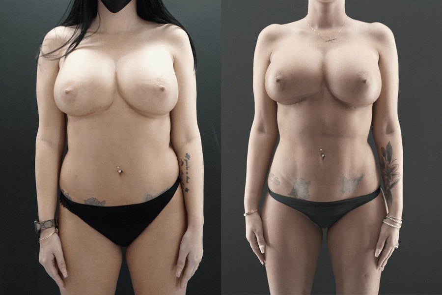 Liposuction PA Front