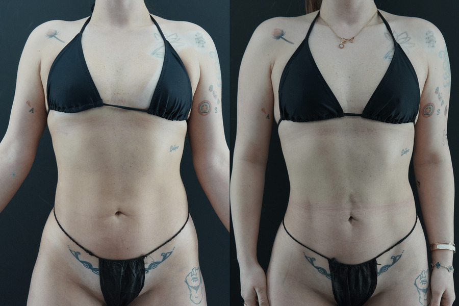 Liposuction PB Front