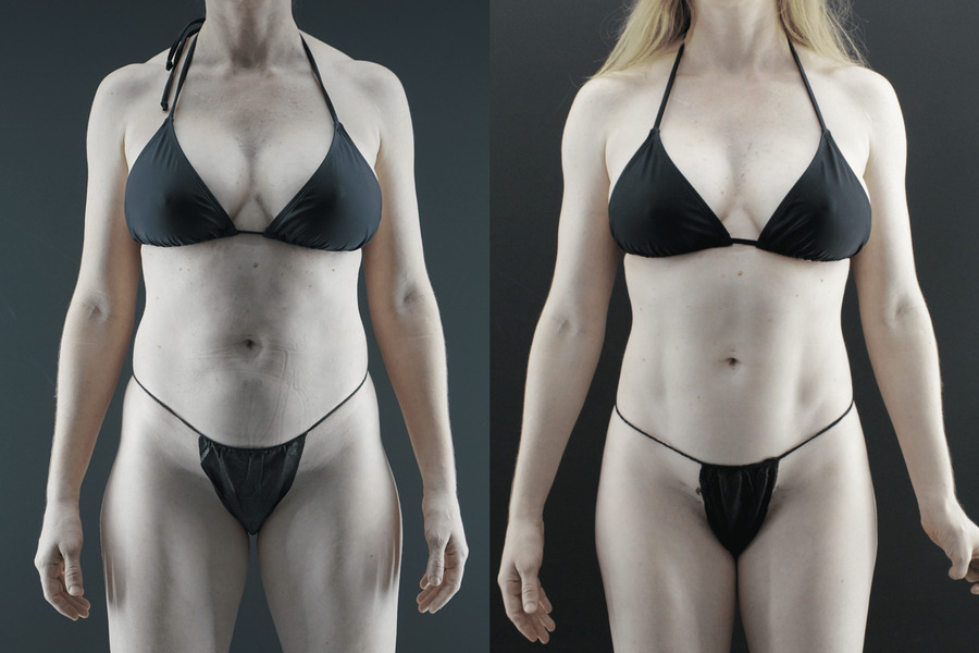 Liposuction PC Front