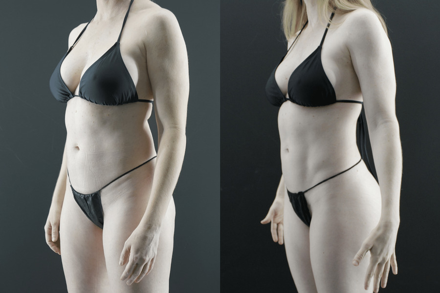 Liposuction PC Side