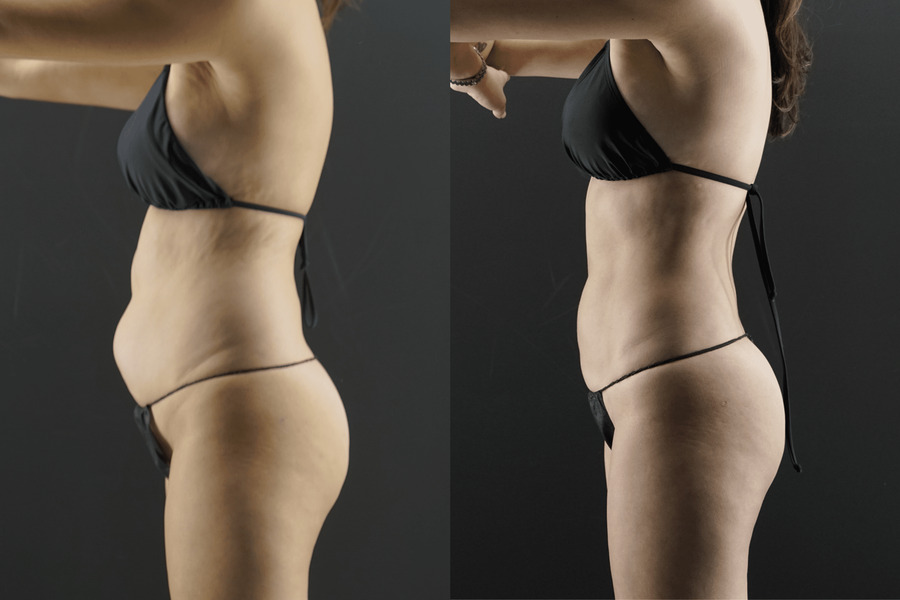 Liposuction PD Lateral