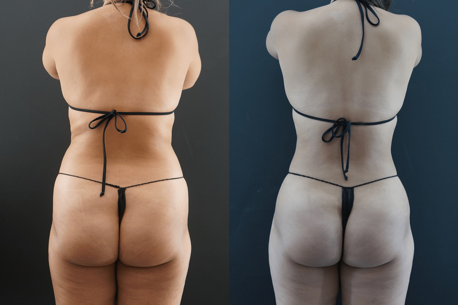 Liposuction PE Back