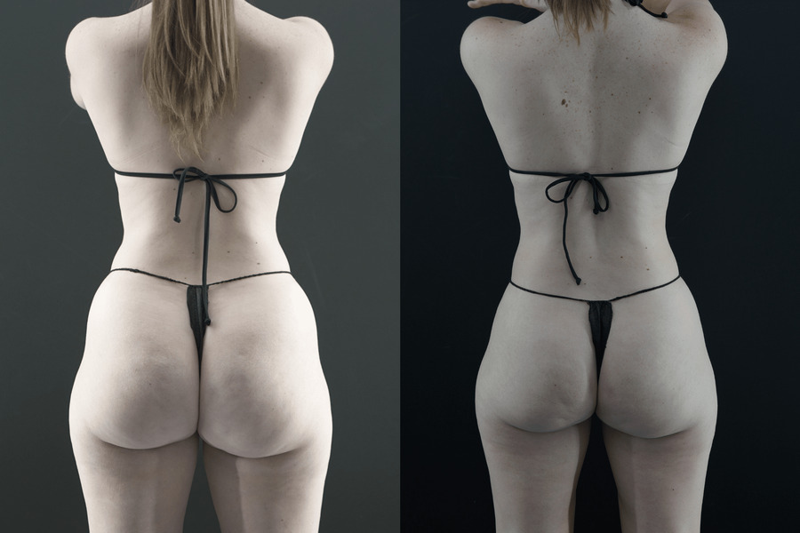 Liposuction PF Back