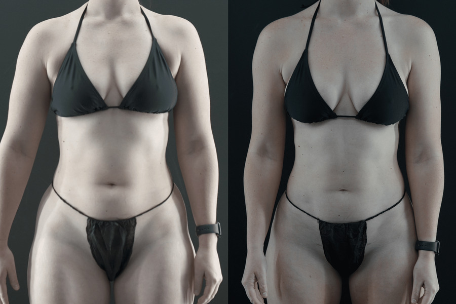 Liposuction PF Front