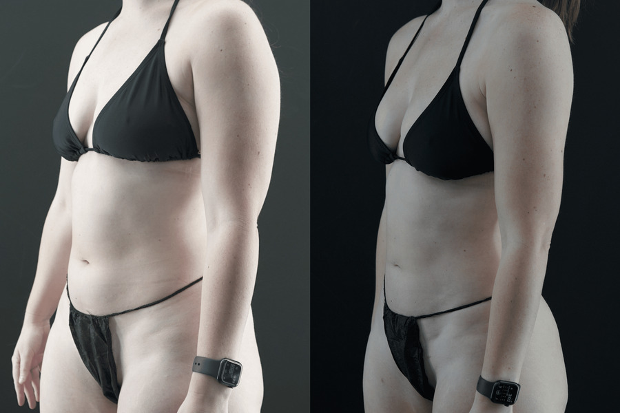 Liposuction PF Side