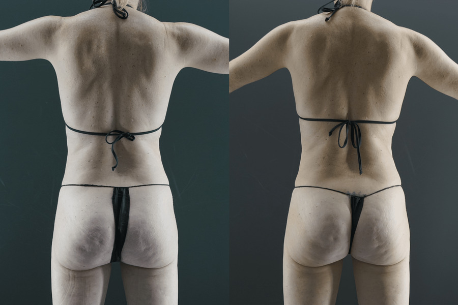 Liposuction PG Back