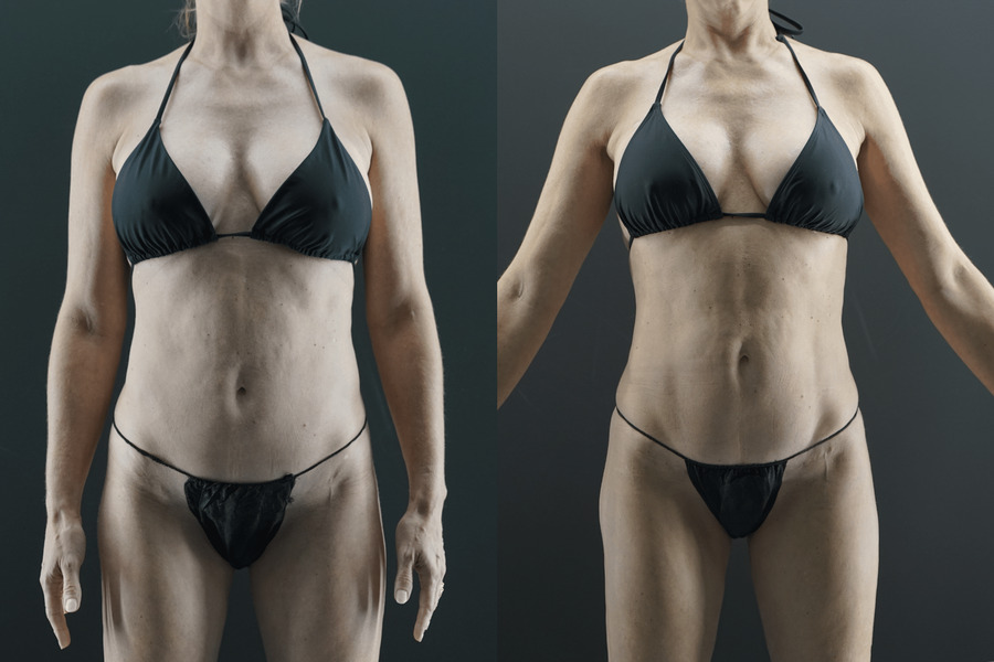 Liposuction PG Front