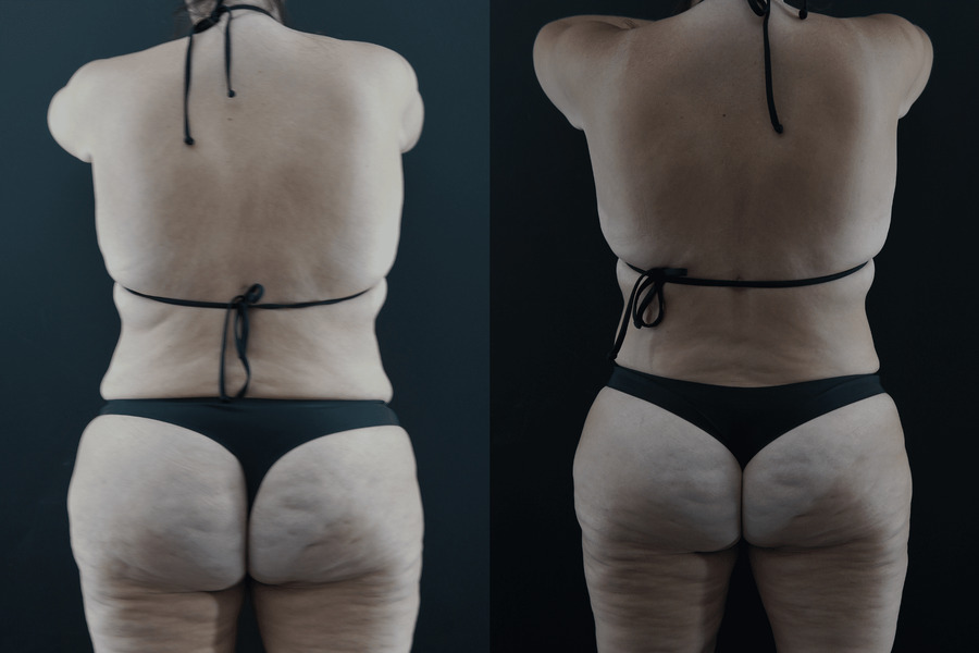 Liposuction PJ Back