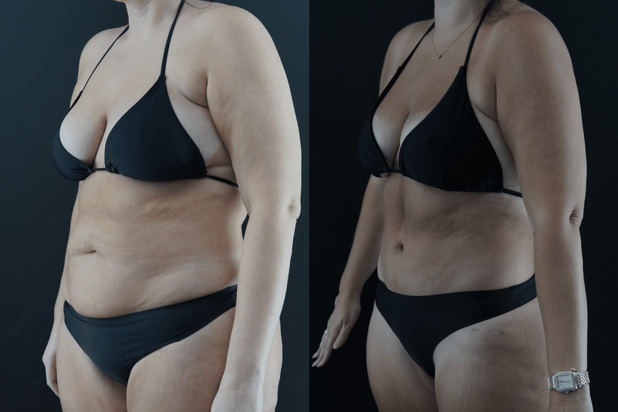 Liposuction PJ Lateral