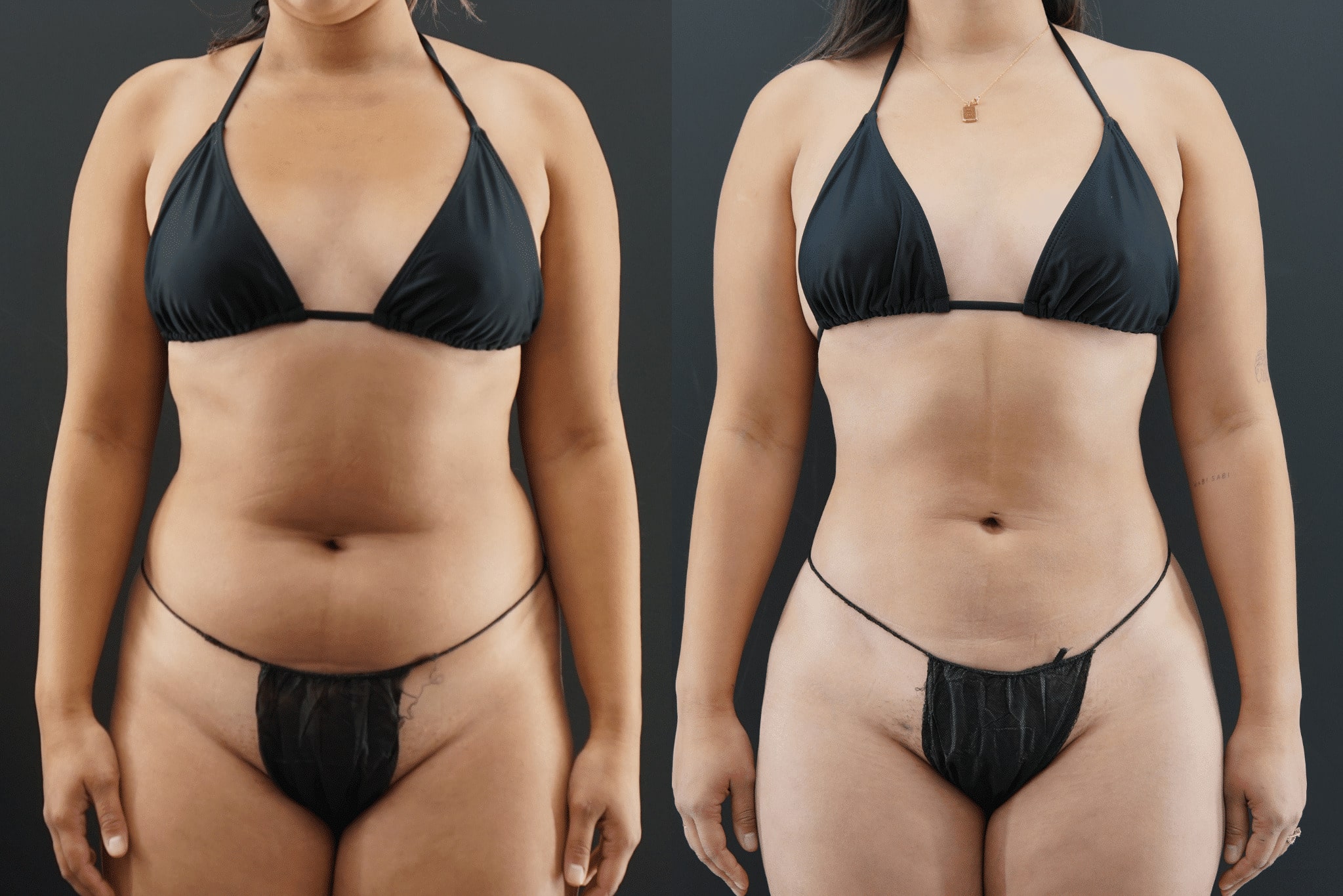 Liposuction Recovery Beverly Hills