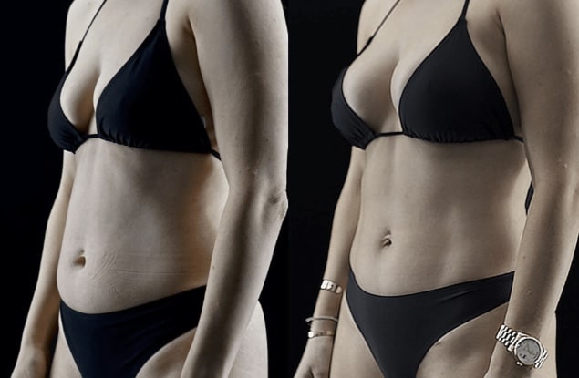 Mini Tummy Tuck Before and After Beverly Hills