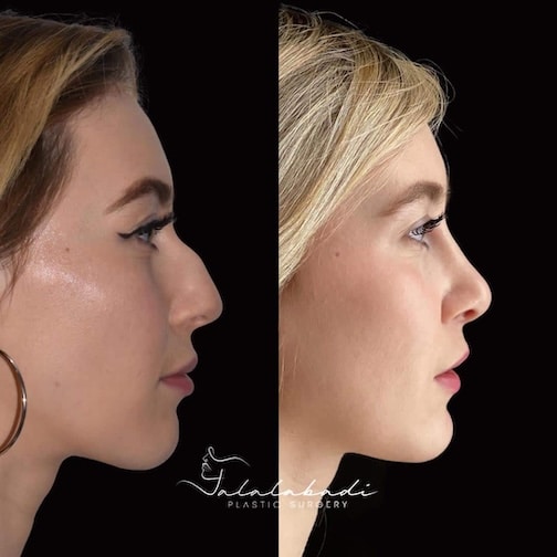 Nose Reshaping Beverly Hills