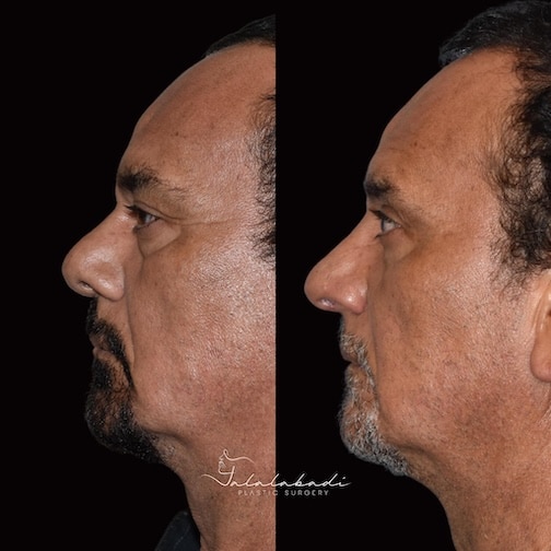 Rhinoplasty Before and After Beverly Hills