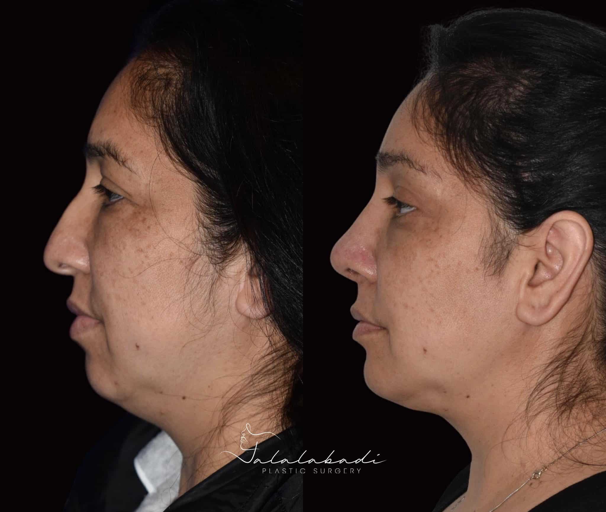 Rhinoplasty-patient-2