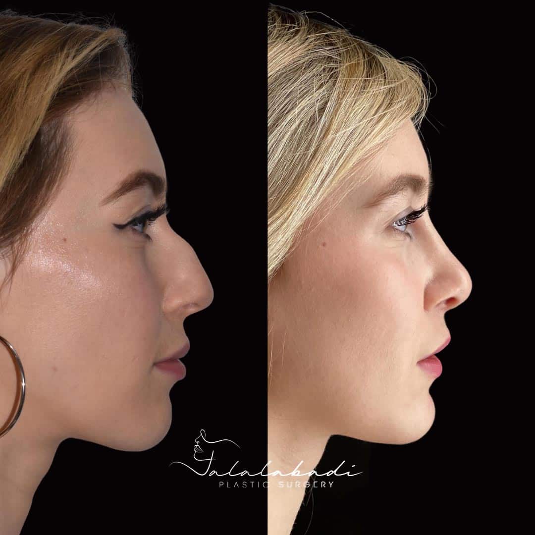 Rhinoplasty-patient-3-3