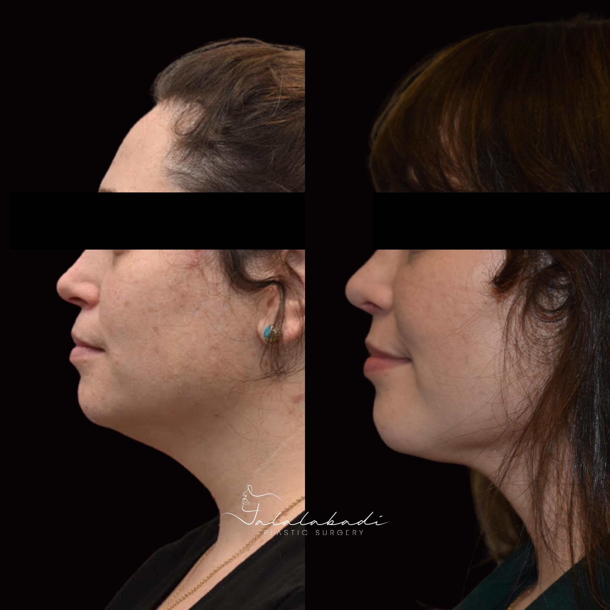 Rhinoplasty-patient-4-2