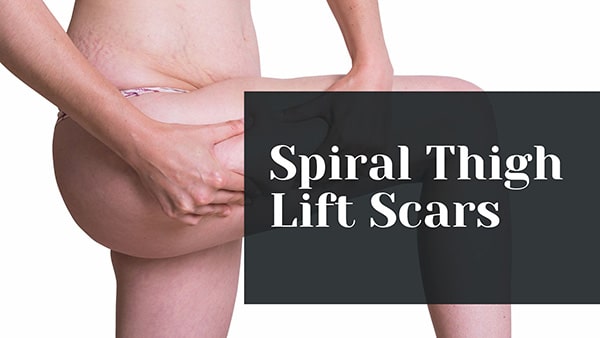 Spiral Thigh Lift Scars