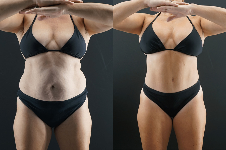 Tummy Tuck Before and After