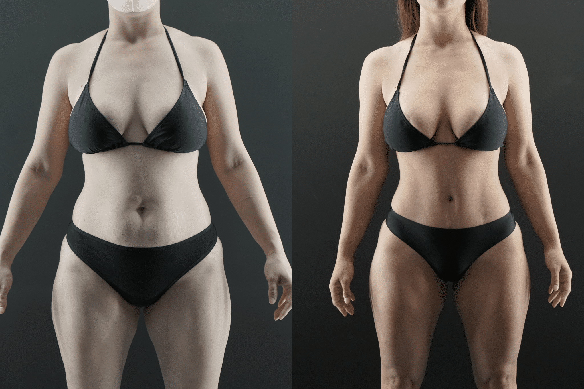 Tummy Tuck Candidate Before and After