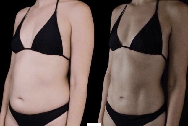 Vaser Lipo before and after stomach