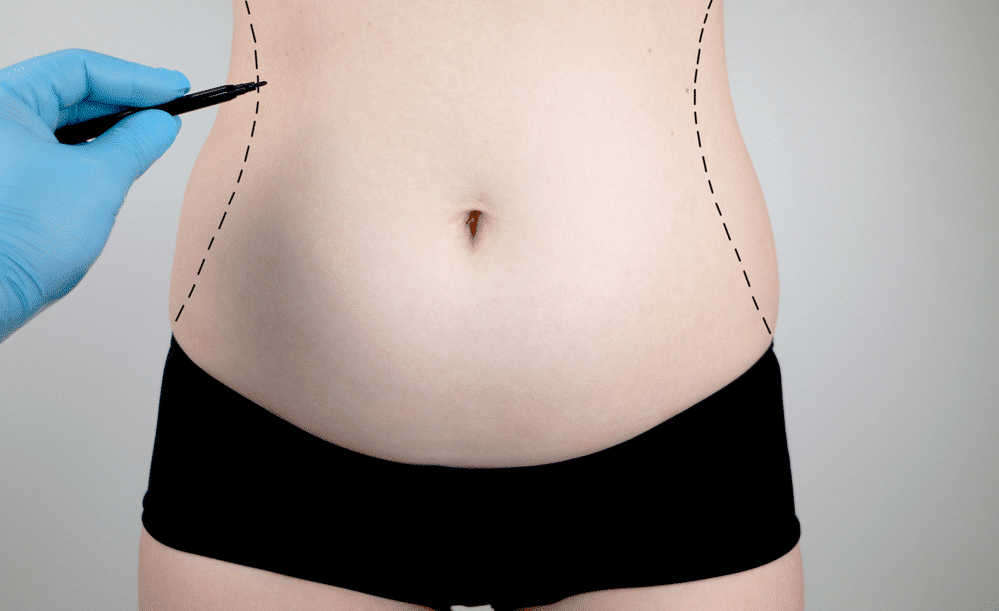 Who Is a Good Tummy Tuck Candidate