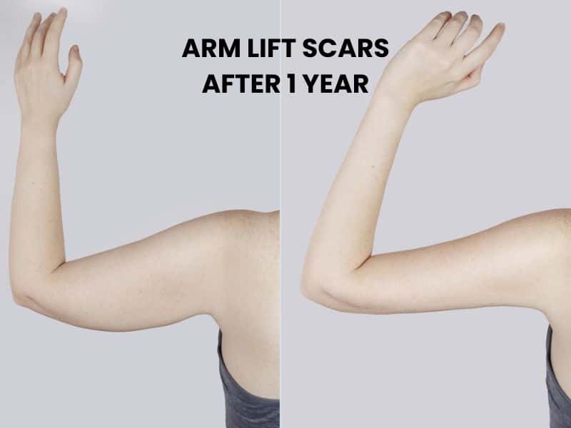 arm lift scars after 1 year