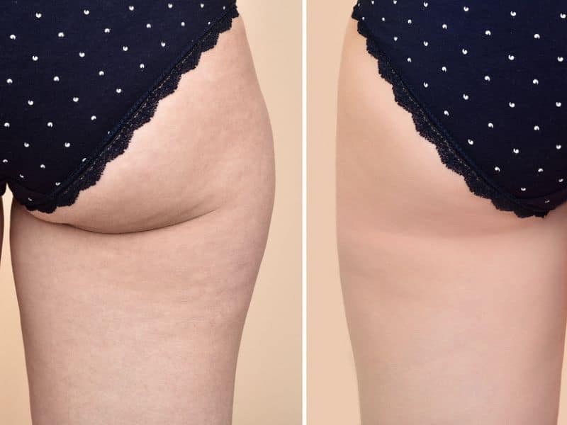 aveli cellulite treatment before and after